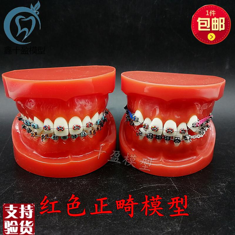 口腔牙列整齐正畸模型红牙列w不齐错颌缺失牙齿仿真牵引皮链支抗