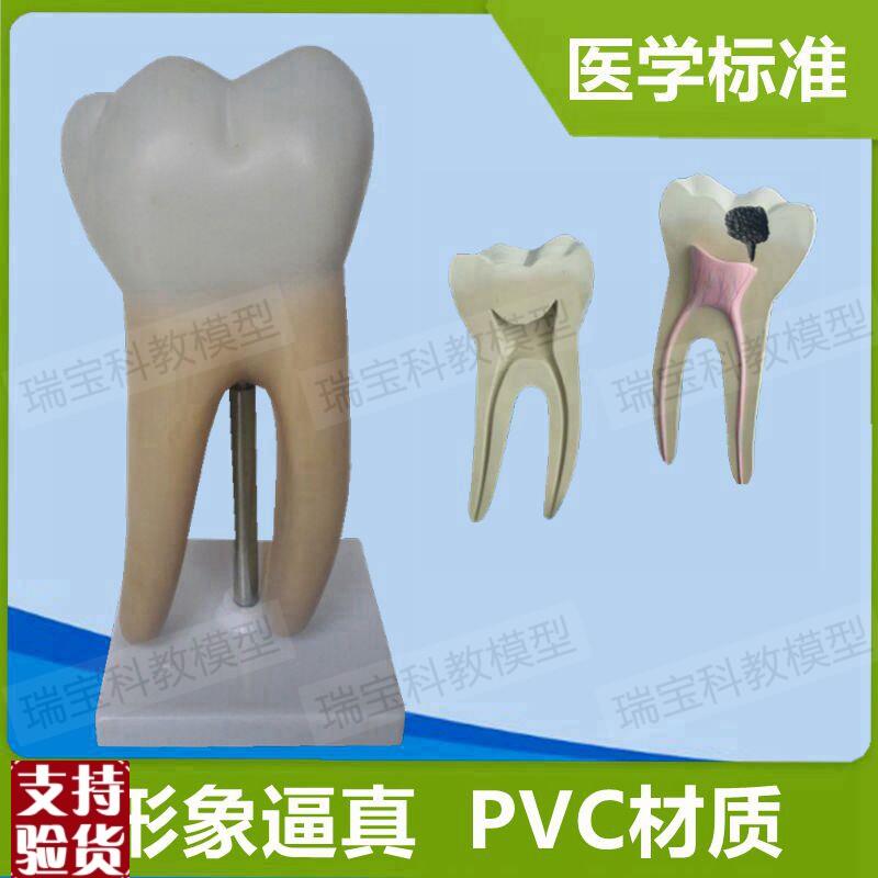 大型磨牙模型可拆卸牙根牙髓腔蛀牙口腔健科普牙U科医生教学器材