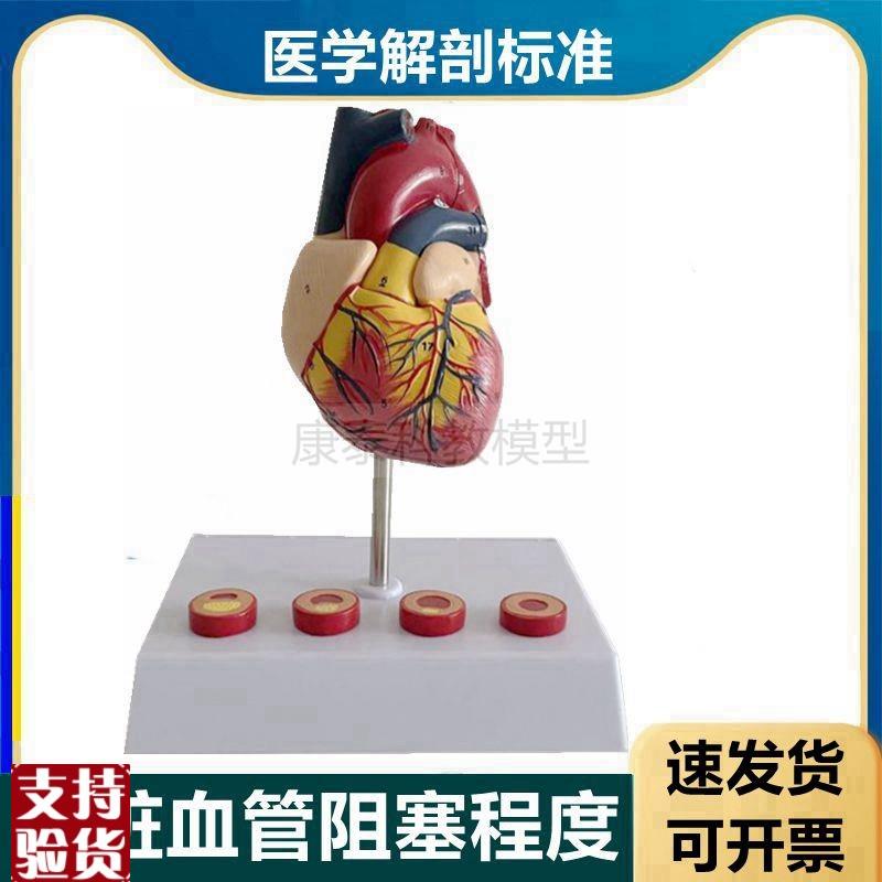 心血管模c型冠状动脉粥样阻塞硬化程度狭窄脂肪斑块内膜栓子医患
