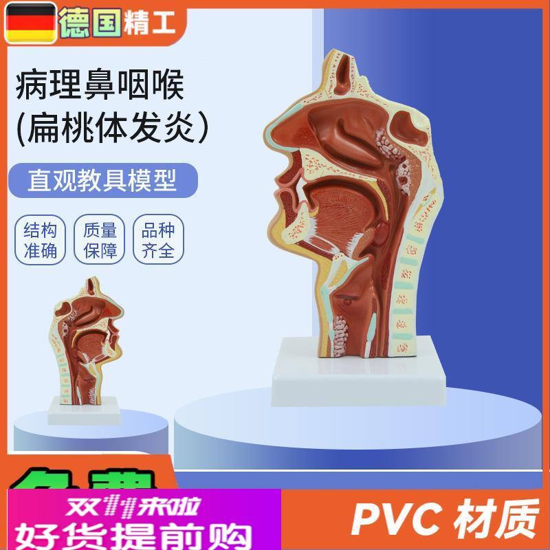 德国】PNT-0736人体鼻腔咽喉解剖教学模型 病理鼻咽喉(扁桃体发