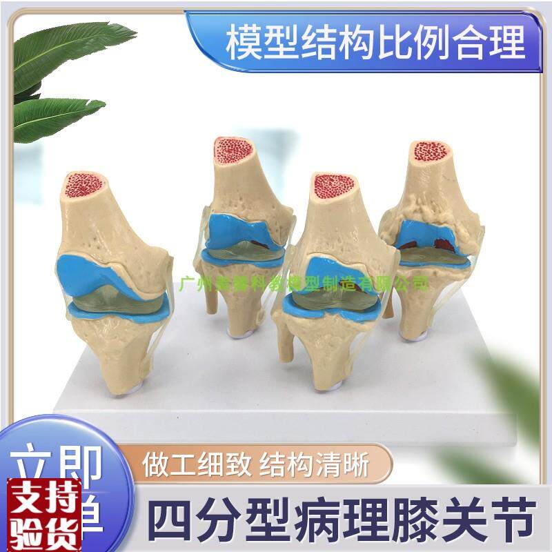 病变膝关节模型退行性关节人体膝关节功K能模型半月板交叉韧带髌