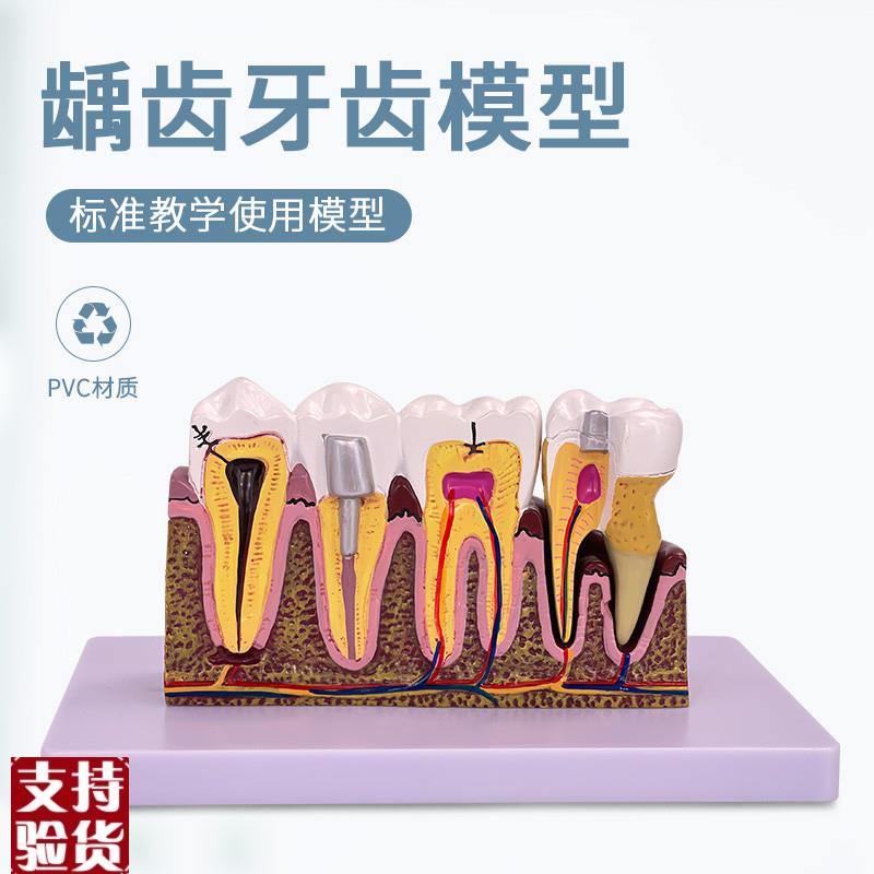 病态牙齿模型虫牙蛀牙牙病牙科疹B所教具美牙牙洞修复牙龈发炎教