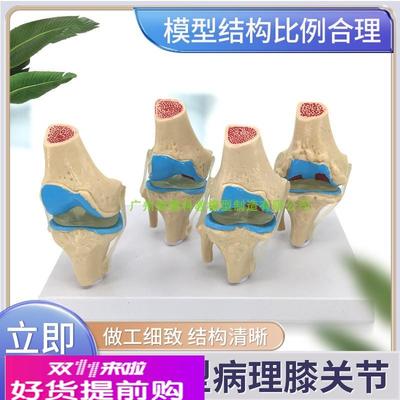 病变膝关节模型退行性关节人体膝关节功能模型半月板交叉韧带髌骨