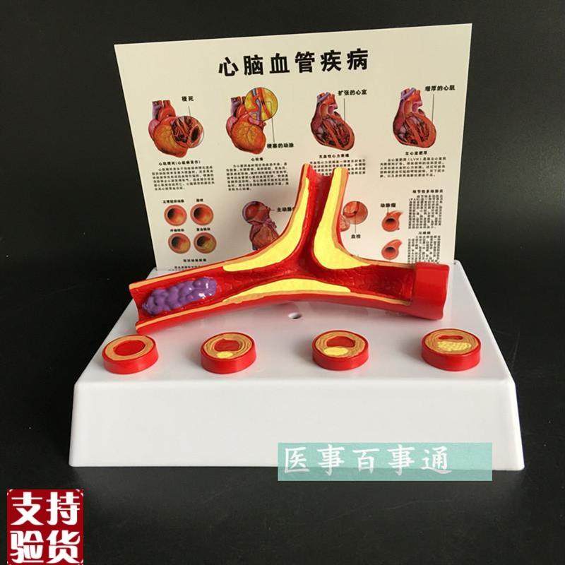 血管模型冠状动脉性心脏病动脉B化模型老年科医患沟通演示模型