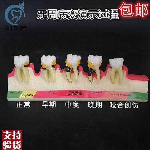 牙齿牙科牙模f牙周分类模型牙周并变重的过程牙科医患沟通展示模