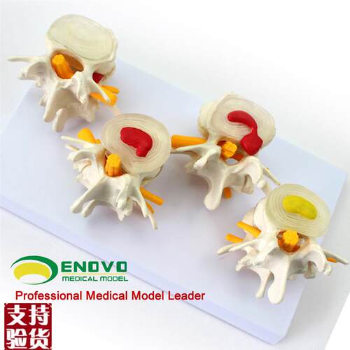 颐诺正品医用腰椎正常与病变y组合模型椎间盘骨科教学骨骼模型