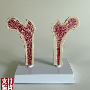 骨质疏松模型f股骨头骨髓密度变化骨科医药促销年龄段脊椎病理医