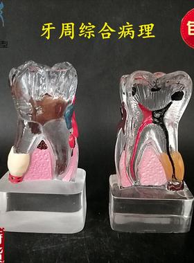 牙科口腔教学g模型教具4倍综合病理模型水晶病理模型M4015透明