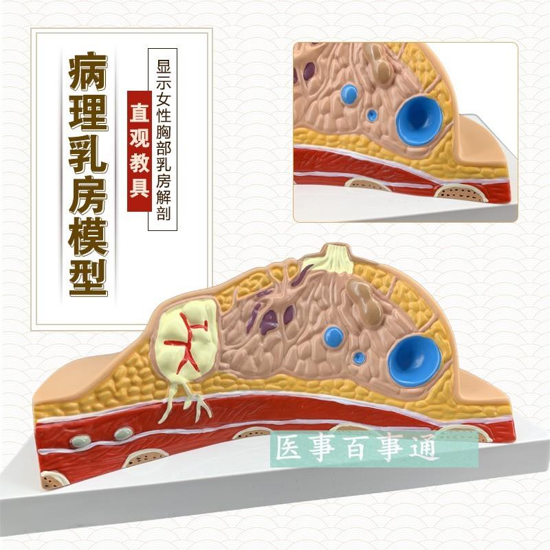 正品乳房常见疾病乳房病理解剖结构模型乳房模具W妇科模型包邮