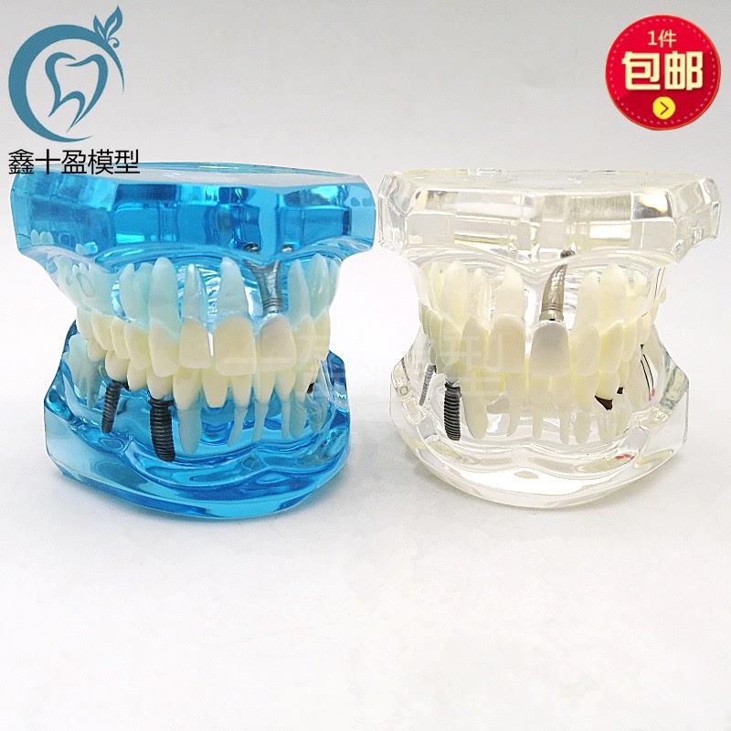 牙科口腔教学可拆卸种植体修复模型活动牙种植牙V医患沟通包邮