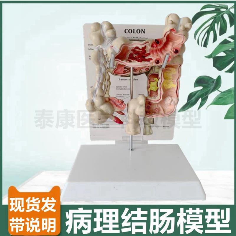 病理大肠模型阑尾盲肠结肠肛肠科医患沟通痔疮消Z化医药礼品