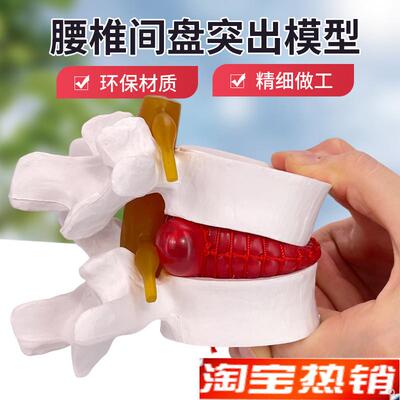 腰椎放大腰椎间盘受压演示模型人B体脊柱脊椎骨病理椎间盘膨出模