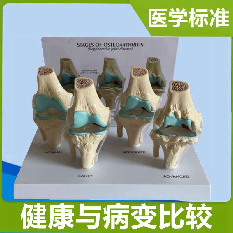 人体膝关节c模型半月板软骨韧带病变劳损骨赘人工假肢医患演示礼