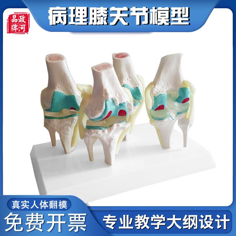 政河病理膝关节人l体骨骼模型膝盖骨头病变演示正骨关节医院学校