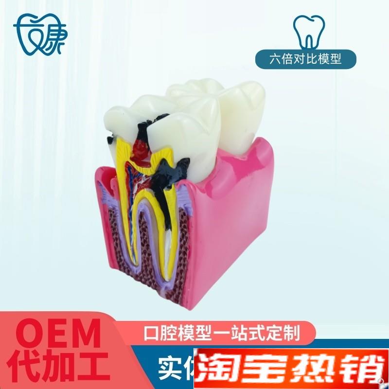 6倍对比模型牙科教学器材6倍z龋齿对比模型口腔模型教学牙齿模型