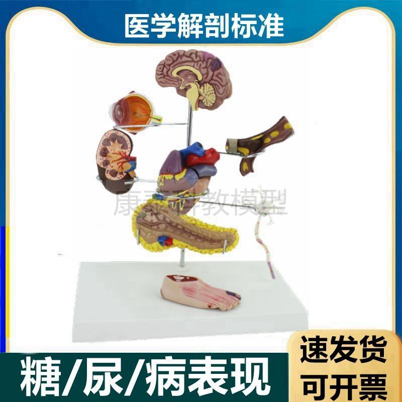 糖尿模型脏器受损病理内分泌医患C沟通眼底脑足心脏血管变化可拆