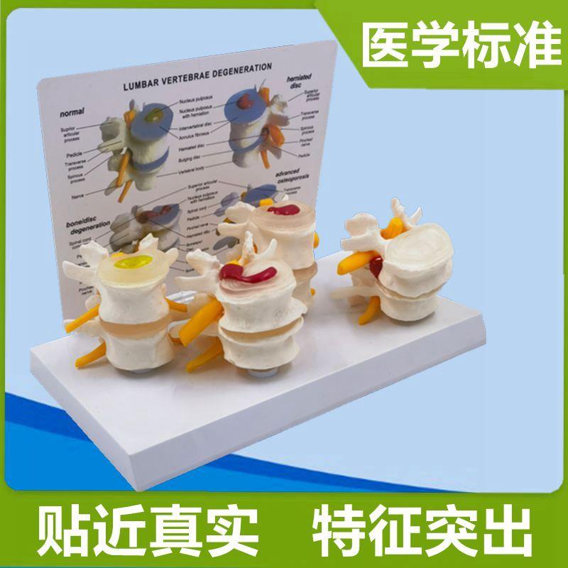 人体脊柱腰椎间盘神经老年人的腰椎四个阶段脊椎变化X受损突出医