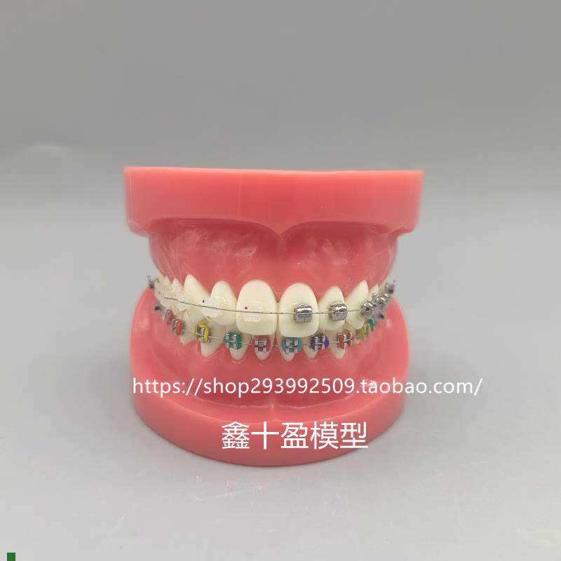 牙科正畸模型球形金属自锁托槽正F畸模型矫正练习模型医患沟通