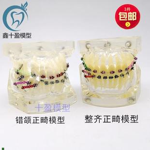 牙科正畸模型透明错颌矫正展示z模型结扎丝托槽正畸带支抗钉牙列
