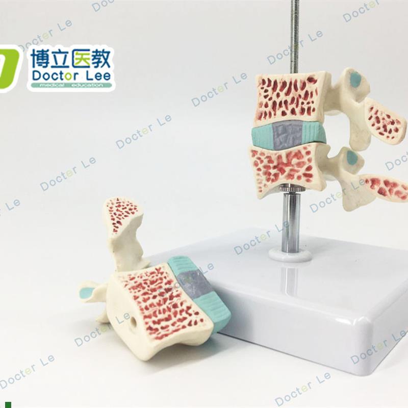 3节脊椎模型腰椎间盘神经脊椎正中切模型骨Y质疏松模型