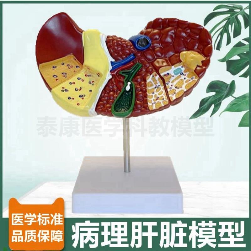 病理肝脏模型临床常见肝胆胰外科医生用胰腺N脾脏十二指肠消化系