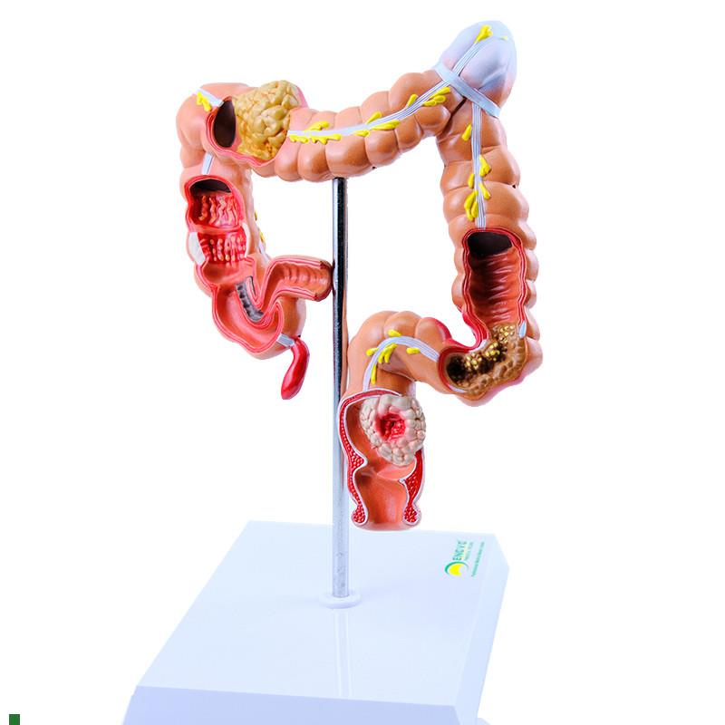 ENOVOd颐诺人体大肠疾病展示模型结肠直肠道病变症状消化系统疾病