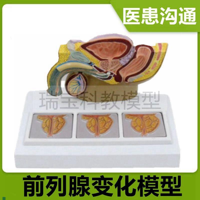 前列腺比较模型病理变化增大生肥尿道狭窄M男科医患中老年人前列