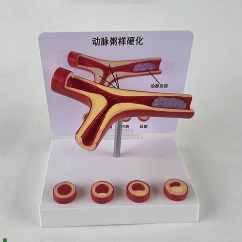 人体血管模型动脉血管结构冠状动脉健F康深静脉栓子临床医患血液