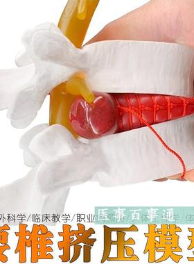 医用人体腰椎间盘TnU出演示模型腰椎D病变模型骨科病理腰椎突出