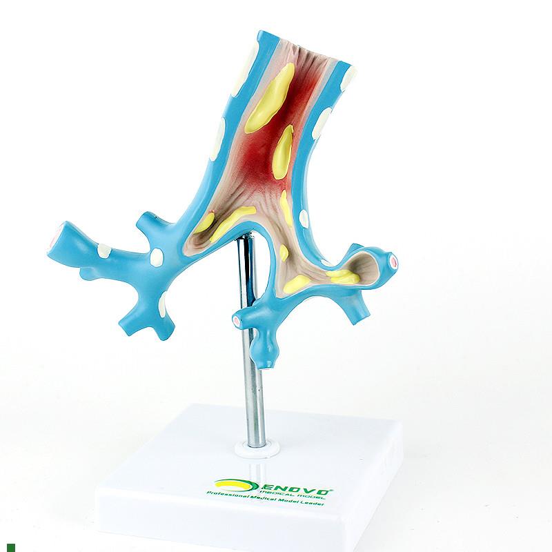 适配ENOVO颐诺支气管疾病支气管炎模型呼吸科病理展示医患沟通教