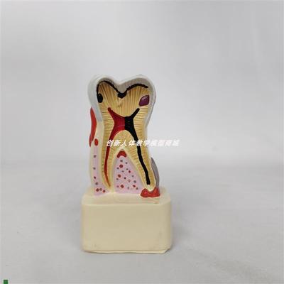 四倍人体牙齿解剖模型牙龈炎蛀齿蛀牙牙齿出N血牙结石切面演示牙