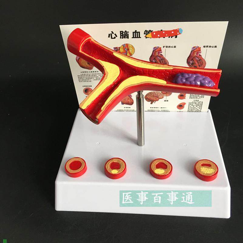 动脉模型心病血管解剖面模型血管模型血N管解剖模型教学包邮