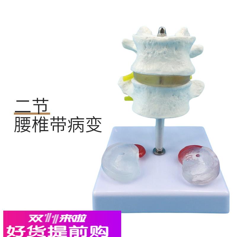 腰椎 二节人体腰椎模型人体腰椎模型椎间盘病变,人体脊柱骨演示