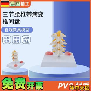 德国】PNT0131三节腰椎带病A变椎间盘病变椎间盘骨骼模型骨科疼痛