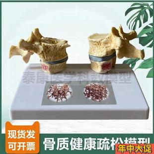 人体骨骼模型脊椎骨n质密度疏松老年人骨骼椎间盘压迫神经演示病