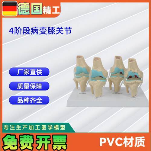 德国】人体4阶段病变膝关节模型J生物医学教学器材模具