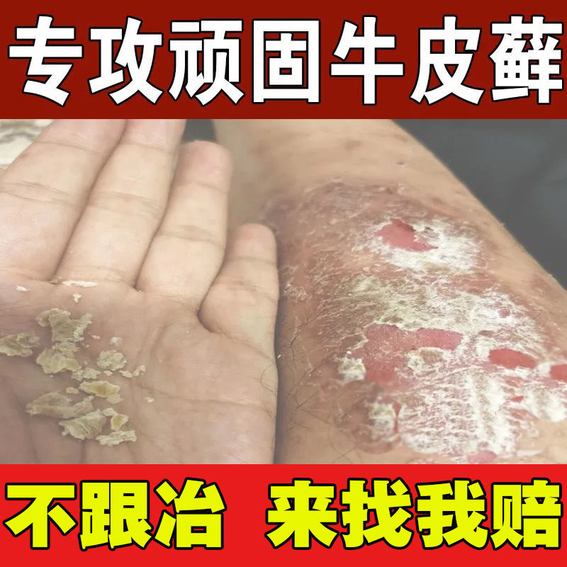 大腿痒皮癣药膏真菌感染头皮屑湿疹专用牛皮癣断根头部洗发水特效