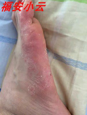 脚底板发白脚气祺臻癣毒灵抑菌药膏成人外用止痒膏防伪四季涂抹皮