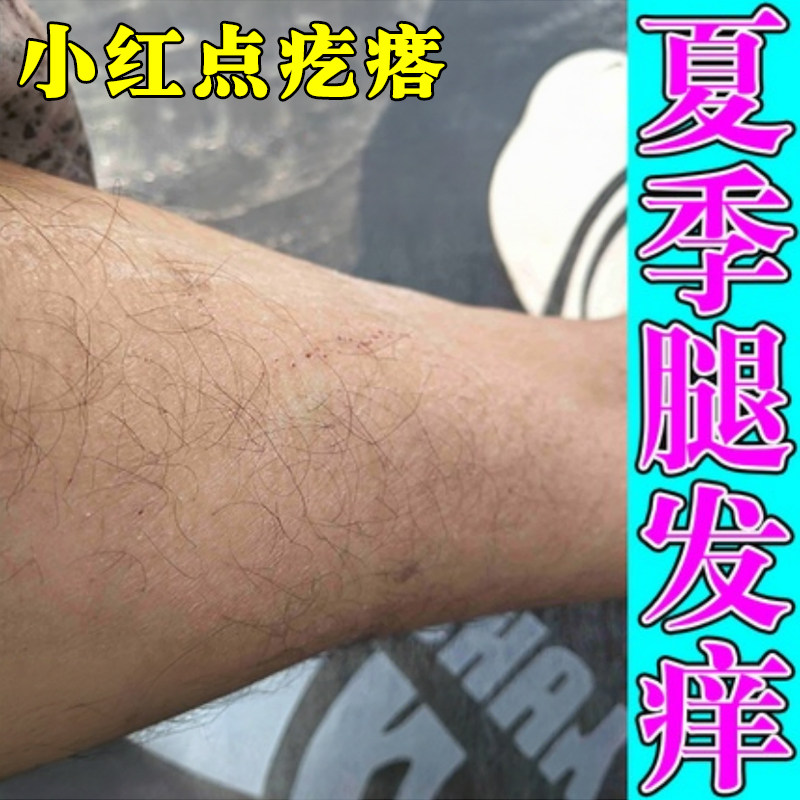 腿痒夏天天气热腿痒起红疙瘩痒的过敏性皮肤痒老人小腿痒专用软膏