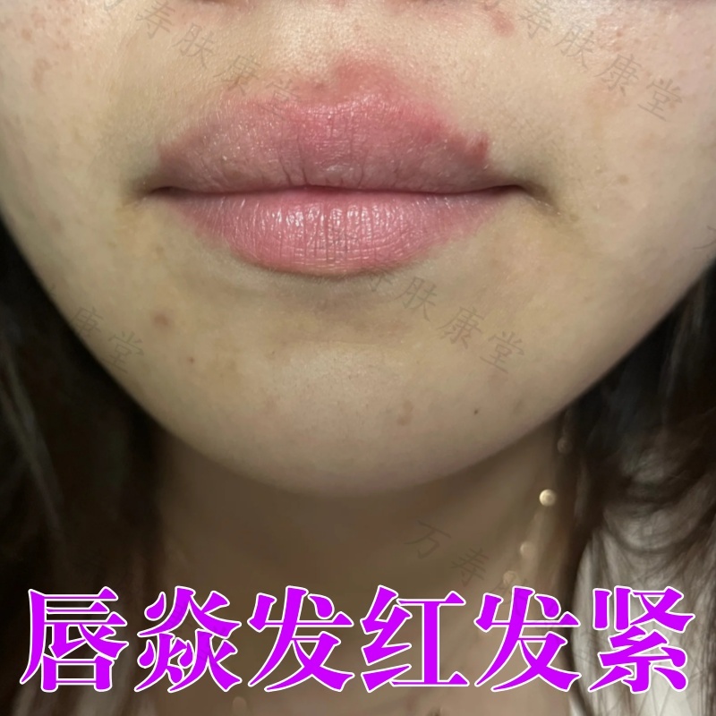 唇焱嘴周围红肿紧绷嘴巴干燥起皮单纯疱泡疹病毒性感染增厚润唇膏