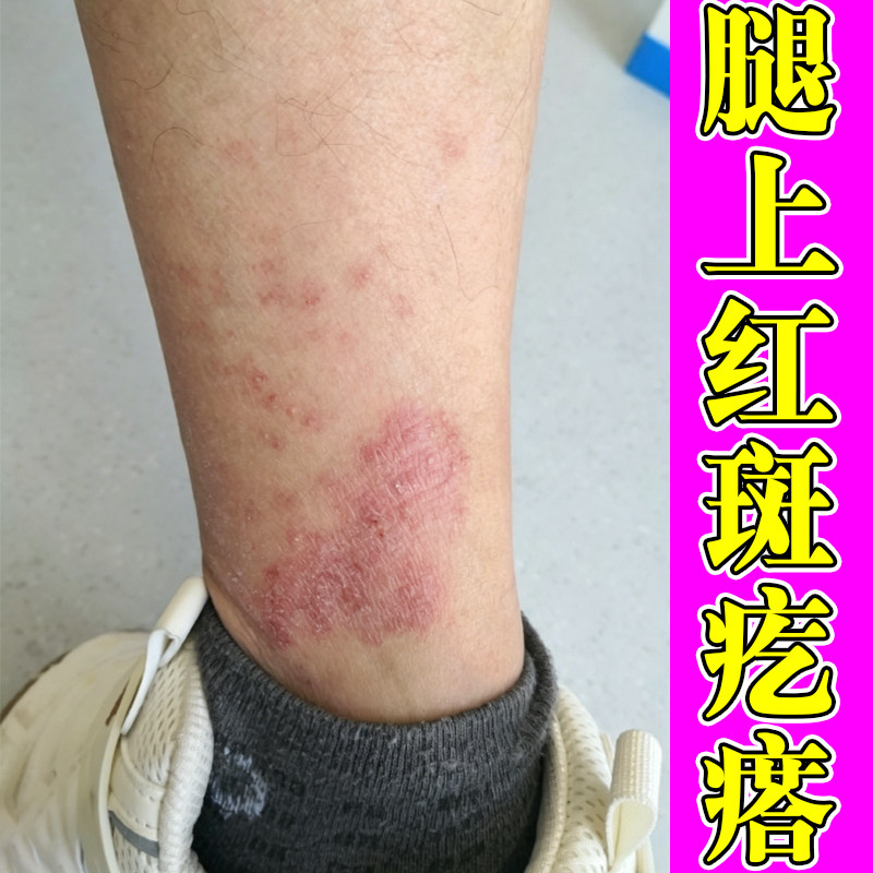 腿上红斑疙瘩干燥粗糙起皮掉屑皮肤过敏增厚小腿泛红发痒