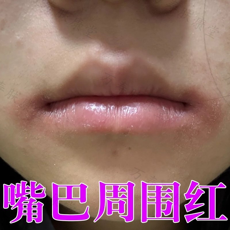 嘴巴周围红羊胡子疮秋冬季嘴巴干裂脱皮小孩舔嘴唇上火烂嘴角唇膏