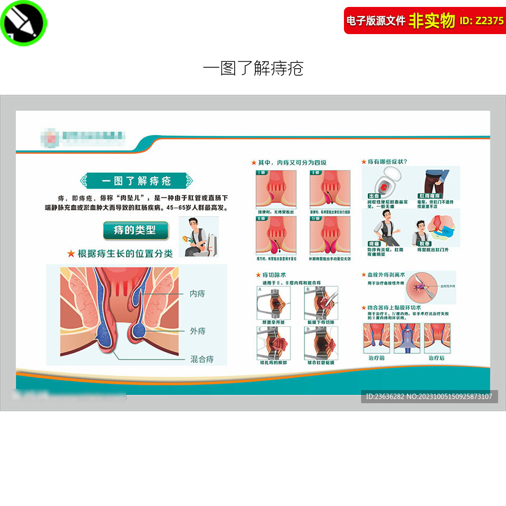 一图了解痔疮展板宣传栏肛门肛肠异物感肛门肿物医院展板挂图素材