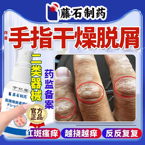 手指关节癣手癣膏真菌感染湿疹脱皮干裂增厚脱屑手足癣鹅掌风YU