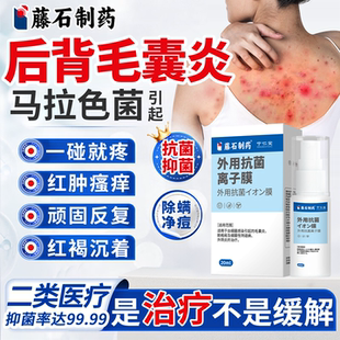 治背后背上长痘痘前胸后背毛囊炎马拉色菌专用膏除螨祛痘痒抗菌YY