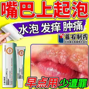 嘴唇单纯疱疹口唇嘴巴上火起泡烂嘴角水泡开裂病毒可搭药膏治特BF