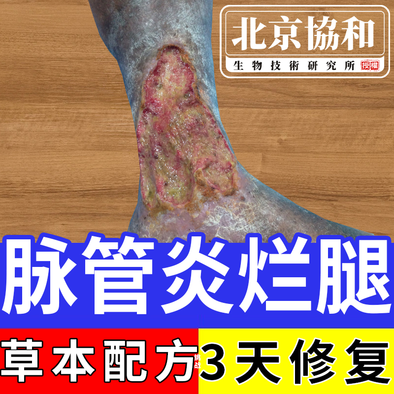 【北京协和】脉管炎烂腿生肌膏