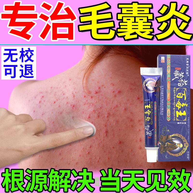 治疗头皮毛囊炎专用鸡皮肤疙瘩毛囊角化特效药膏头上长痘痘洗发水