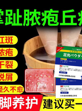脚掌趾脓疱病掌跖脓包角化病症泡脚包js专用脓包角化脱皮干裂