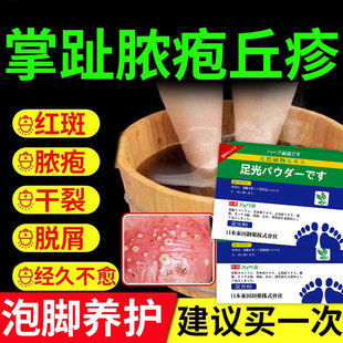 脚掌趾脓疱病掌跖脓包角化病症泡脚包js专用脓包角化脱皮干裂